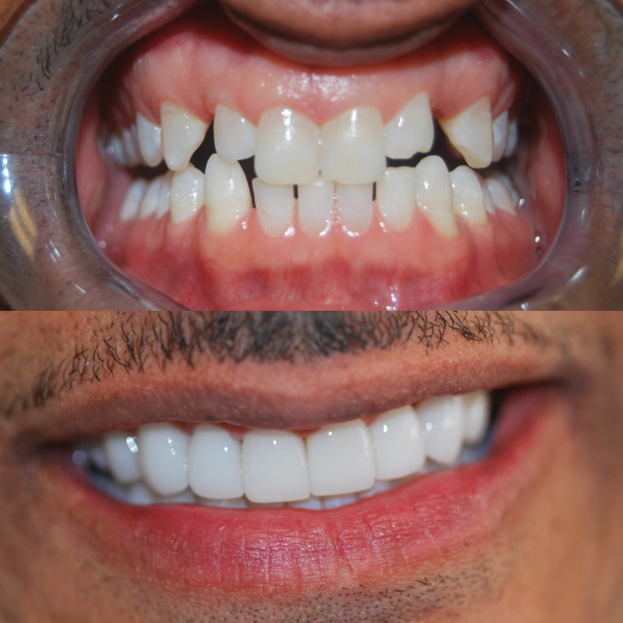 before and after veneers at cupertino dental and facial esthetic before and after veneers at cupertino dental and facial esthetic