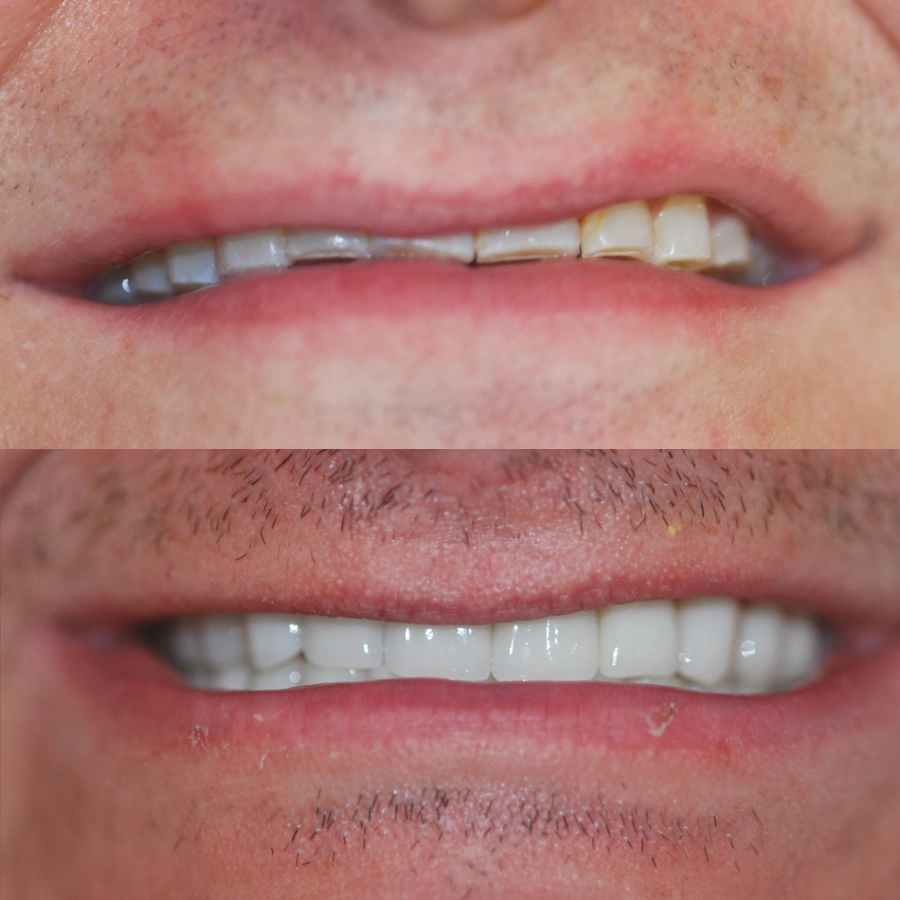 before and after veneers at cupertino dental and facial esthetic before and after veneers at cupertino dental and facial esthetic